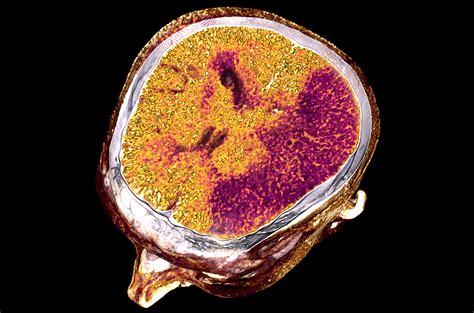 stroke scandal|NIH puts hold on $30 million trial of potential stroke drug.